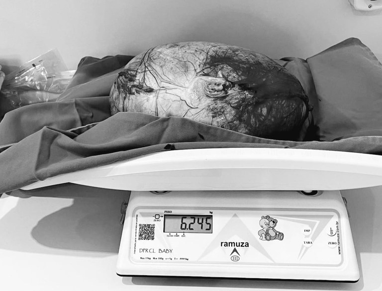 Jovem retira cisto de 6,2 quilos do ovário no Hospital de Guarabira, na Paraíba